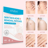 Beauty Acne Patch | Wart Removal Stickers | EasyMon